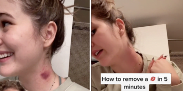 How to Get Rid of a Hickkey Ticktok